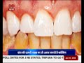 रसायनों से दांत को पहुंचता है नुकसान