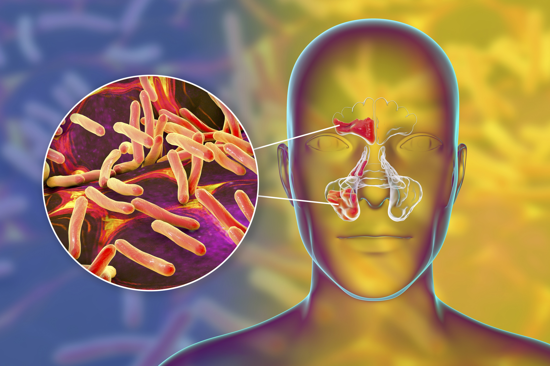 Untreated sinusitis can lead to fungal infections, life-threatening complications