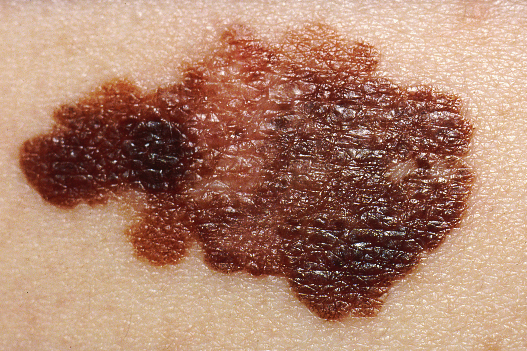 Combination immunotherapy shows promise in treating advanced  skin cancer