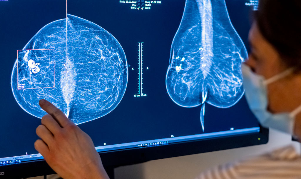 Study reveals Australia and New Zealand have the highest global breast cancer rates