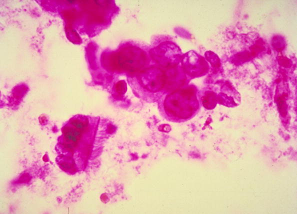 Disrupted Sleep Cycles Linked to Aggressive Breast Cancer: Study