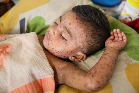 Researchers identify antibodies that may prevent and treat measles infections